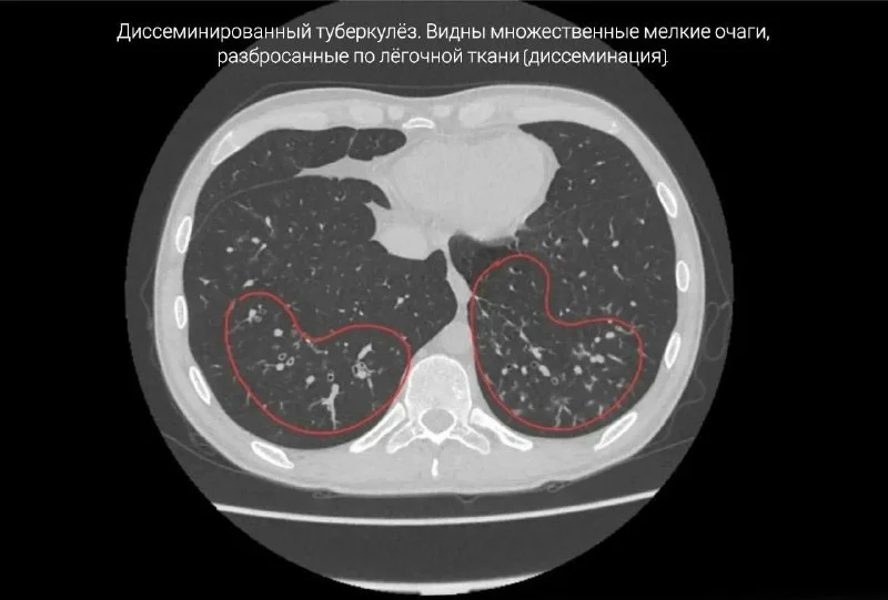 История болезни 33-летнего пациента из Приморья закончилась летальным исходом