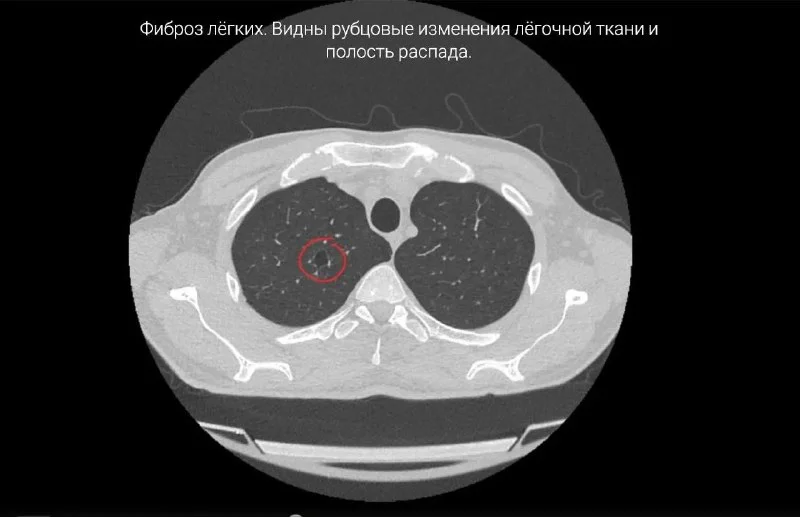 История болезни 33-летнего пациента из Приморья закончилась летальным исходом